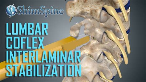 InterLaminar Decompression and Instrumentation - ShimSpine