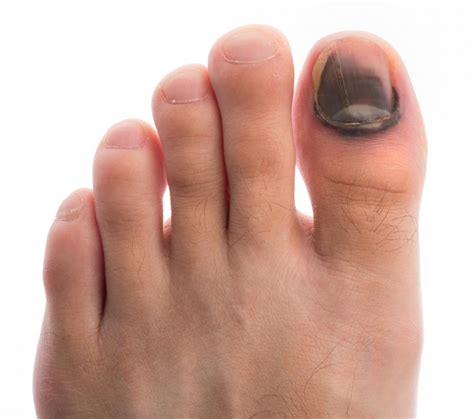 What Is a Toenail Melanoma? (with pictures)