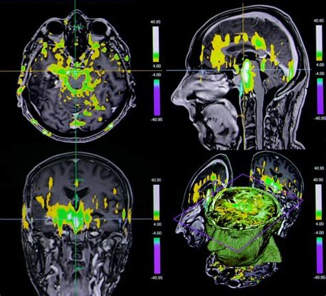 Brain Connectivity Patterns on fMRI Differ in Chronic and Episodic Migraine - Neurology Advisor