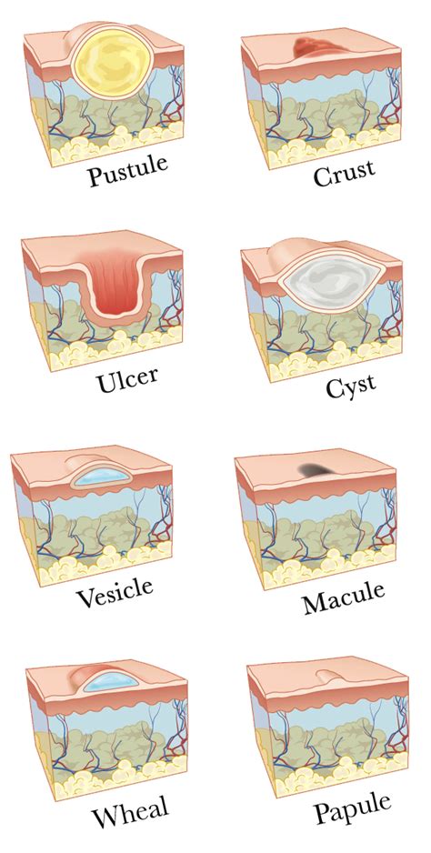 Let's Talk Lesions — Retief Skin Center | Nashville's Best ...