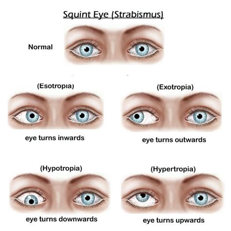 What is Strabismus (Squint)? Is a condition where the eyes do not look ...