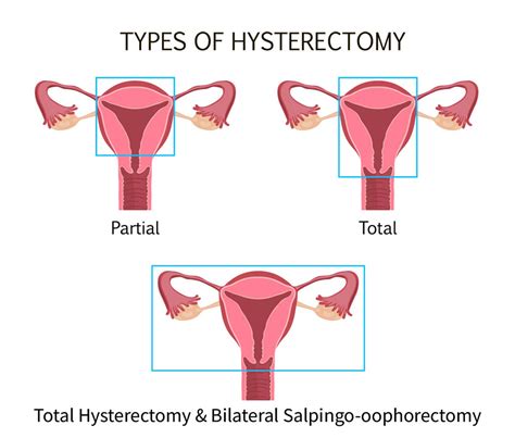 The Experts Weigh In: Is A Hysterectomy An Effective Endometriosis Tre ...