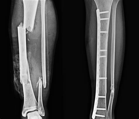 What to Expect From a Complicated Fracture Injury - Bay Area Bicycle Law, P.C.