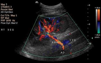 Renal Artery Duplex Scanning | Vascular Center | UC Davis Health