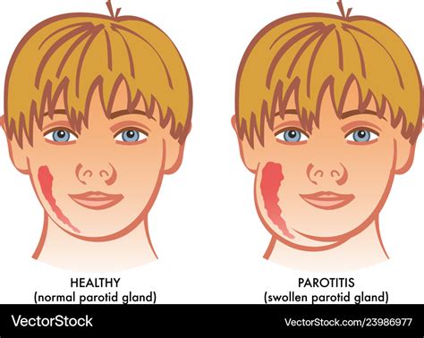 Parotitis Royalty Free Vector Image - VectorStock