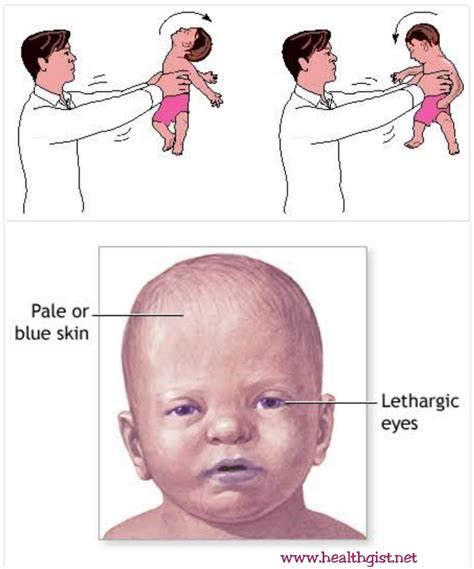 Shaken Baby Syndrome | HealthGist.Net