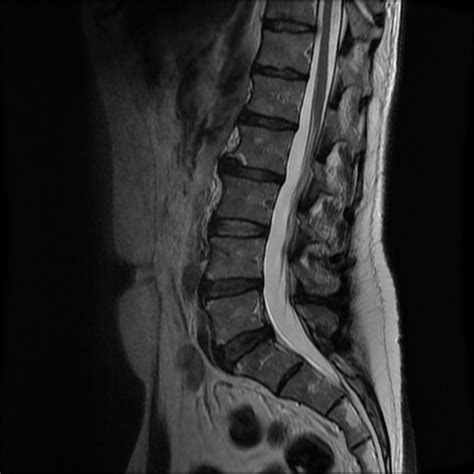 Lumbar Spine Mri Bulging Disc