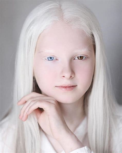 Albinism - Types, Symptoms, Causes & Treatment - Santripty