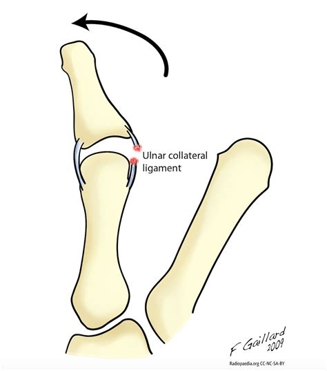 Ulnar collateral ligament (UCL) injury of thumb – The Lothian Hand Unit