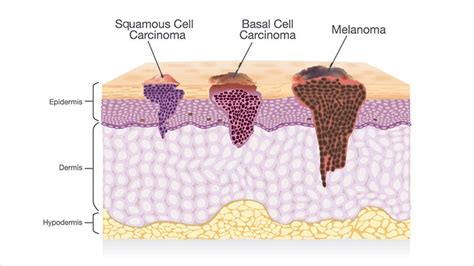 Other Skin Cancers - AIM at Melanoma Foundation