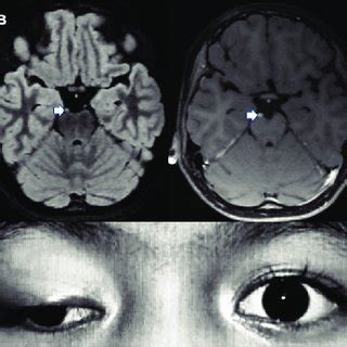 (a) Right eye ptosis with a "down and out" position of the eyeball... | Download Scientific Diagram