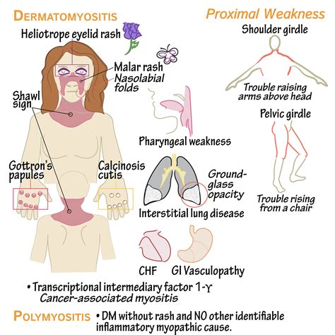 Polymyositis and Dermatomyositis. Pathophysiology | by Aayush Pokharel | Medium