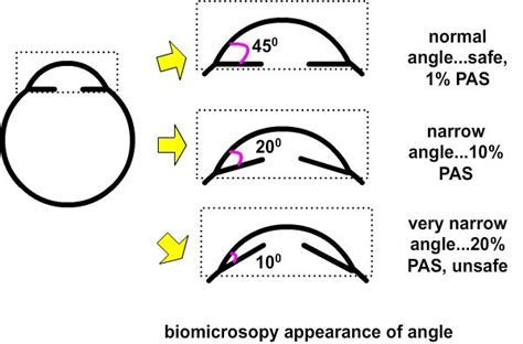 Anatomic Narrow Angles