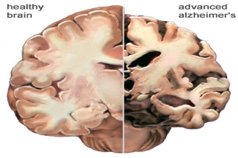 What really causes Alzheimer's and how might we fix it?