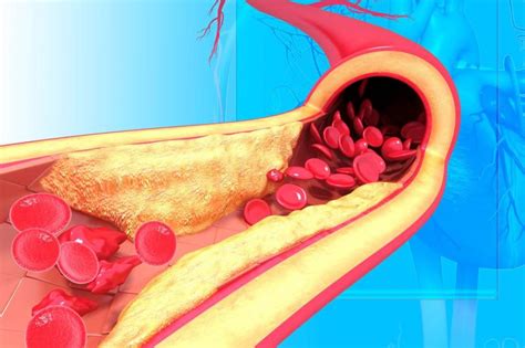 Heart Health Revolution: Atherosclerosis Treatment Drugs