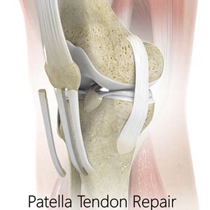 Patellar Tendon Repair Surgery Virginia Beach | Patellar Tendon Rupture Norfolk, VA