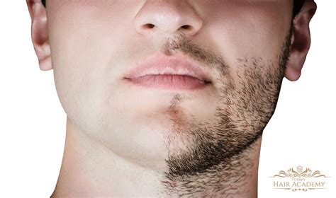 Beard Transplant Guide 2022: Prices, Procedures, Best Clinic