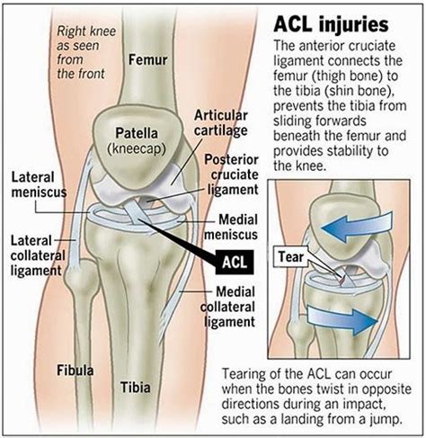 ACL - GeraldJaimie