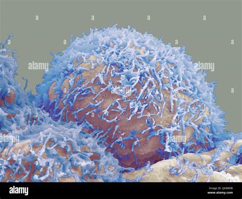 Prostate cancer cells, SEM Stock Photo - Alamy