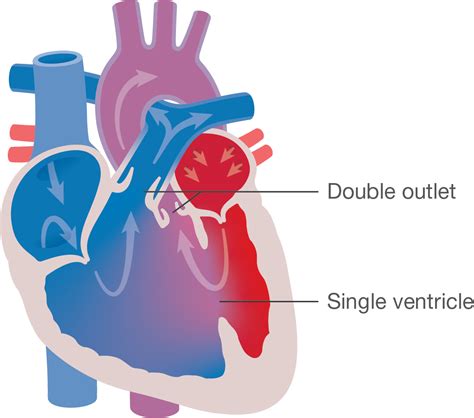 Double Outlet Right Ventricle (DORV) Boston Children's, 50% OFF