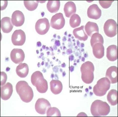 Platelet Clumping or Aggregation | Medical Laboratories