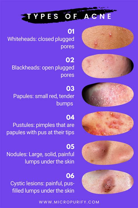 What type of acne do you have? | Types of acne, Skin care acne, Natural ...