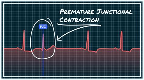 What Premature Junctional Contraction (PJC) Looks Like on Your Watch ECG | Qaly