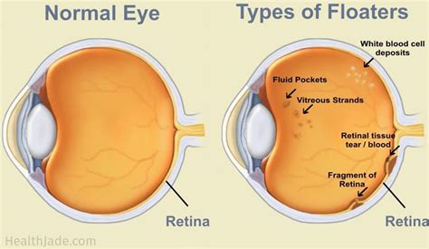 Floaters - Cataract & Laser Institute - Eye Doctor in Medford, Oregon