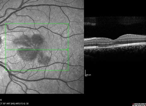 Paracentral Scotoma - Outlook Eye Specialists