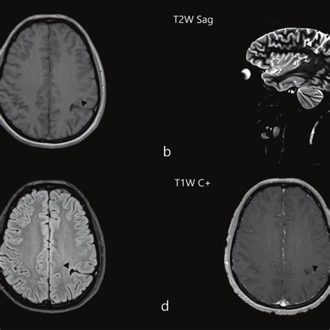 a. Axial T1 weighted MRI (arrowhead: The cleft of schizencephaly) B ...