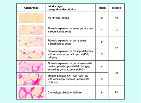 Liver Fibrosis Scale