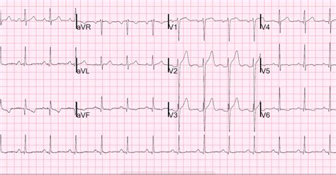 Dr. Smith's ECG Blog: Anterior ST elevation: Anterior STEMI? A ...