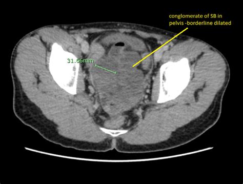 -CT scan-axial view: showing a conglomerate of jejunal and ileal bowel... | Download Scientific ...