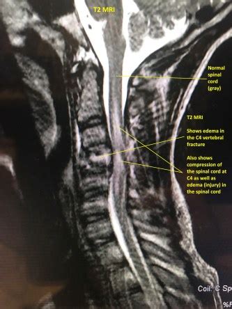 Complex Cervical Spine Surgery – Matthew Lawson, M.D.