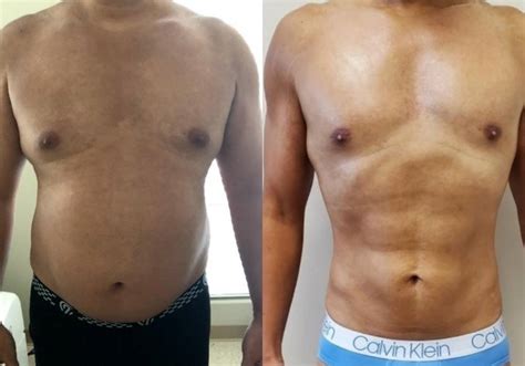 Laser Lipo Treatment For in Orange County