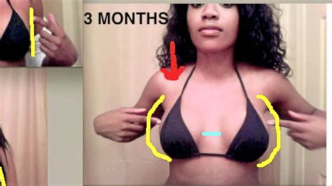 Breast Implants Before and After progression - YouTube