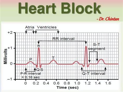 Heart block and ECG