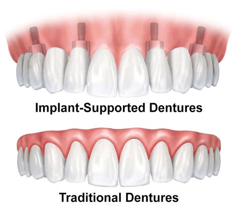 Denture Types - Scottsdale, AZ Partial, Full-Arch, Dental Implant-Supported