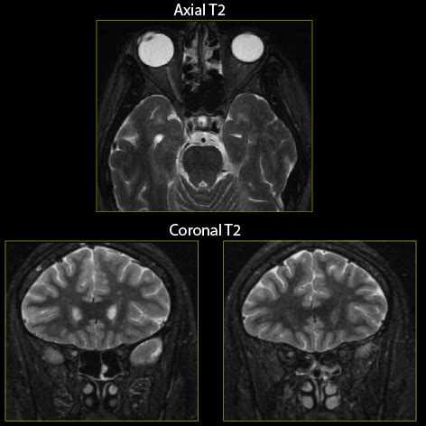 Neuromyelitis Optica (NMO) - Clinical Pathology Flashcards | ditki ...