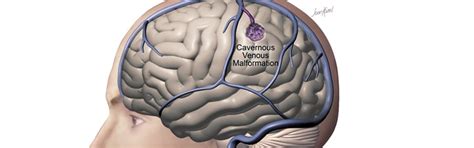 Cavernous Venous Malformation