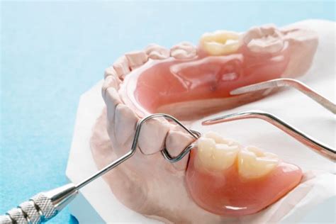 Maxillary Removable Partial Denture