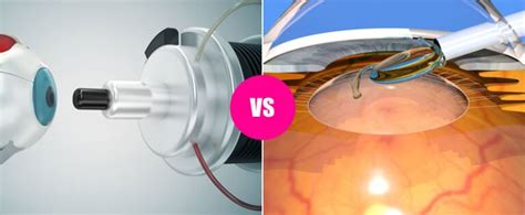 Laser Eye Surgery vs Lens Replacement surgery – What Do You Need to Know?