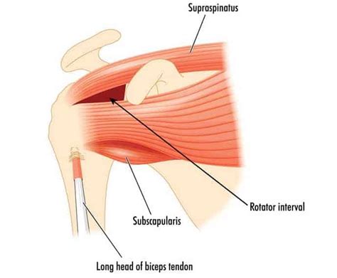 Top 6 Supraspinatus Exercises for Rehabbing an Injured Shoulder | Precision Movement