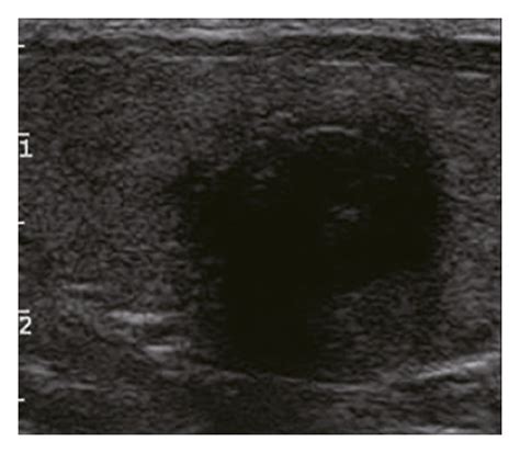 Adjustment of C-TIRADS classification of thyroid nodule with no... | Download Scientific Diagram