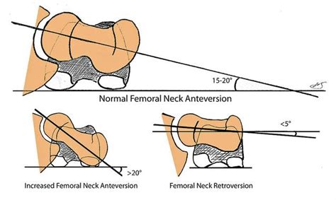 Femoral Anteversion : 네이버 블로그