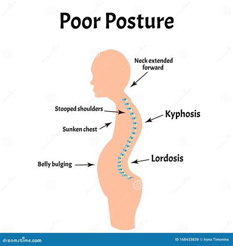 Improper Posture Symptoms. Text Neck Syndrome. Spinal Curvature, Kyphosis, Lordosis, Scoliosis ...