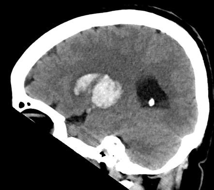 Basal ganglia hemorrhage | Image | Radiopaedia.org