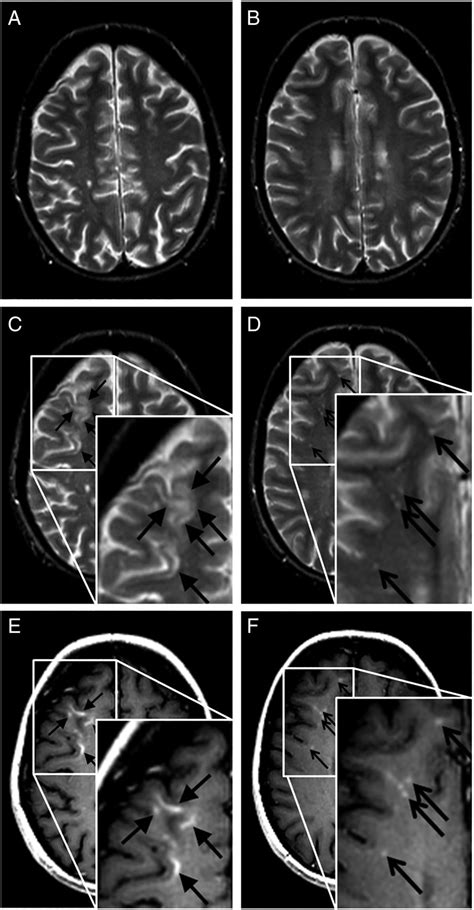 MRI criteria differentiating asymptomatic PML from new MS lesions during natalizumab ...