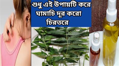 ঘামাচি দূর করার উপায় || Home Remedy To Cure Itchy Skin Problem || Heat Rash || Sweat Rash ...