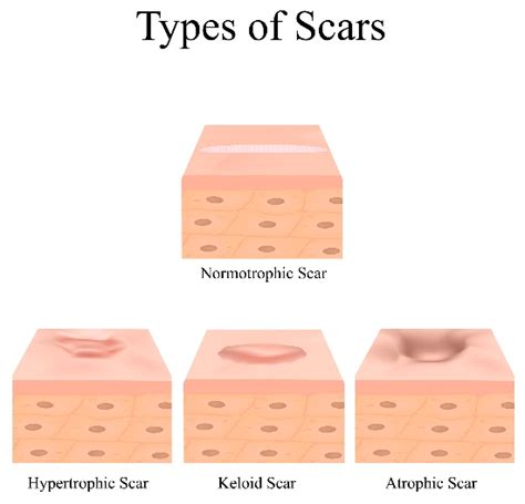 Scar Treatment Mount Martha - Laser | Skin Needling | Chemical Peels